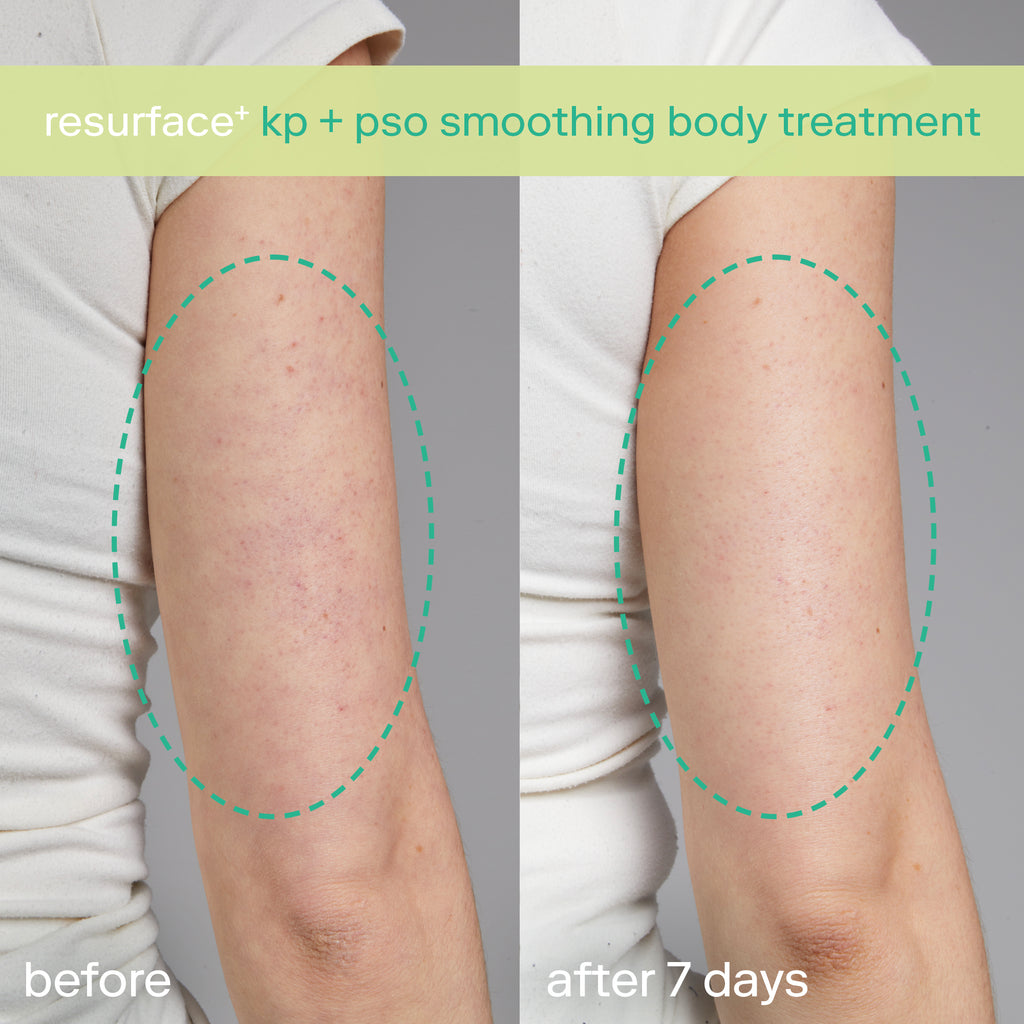 KP + PsO Smoothing Body Treatment before & after keratosis pilaris
