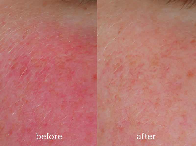 redness before and after