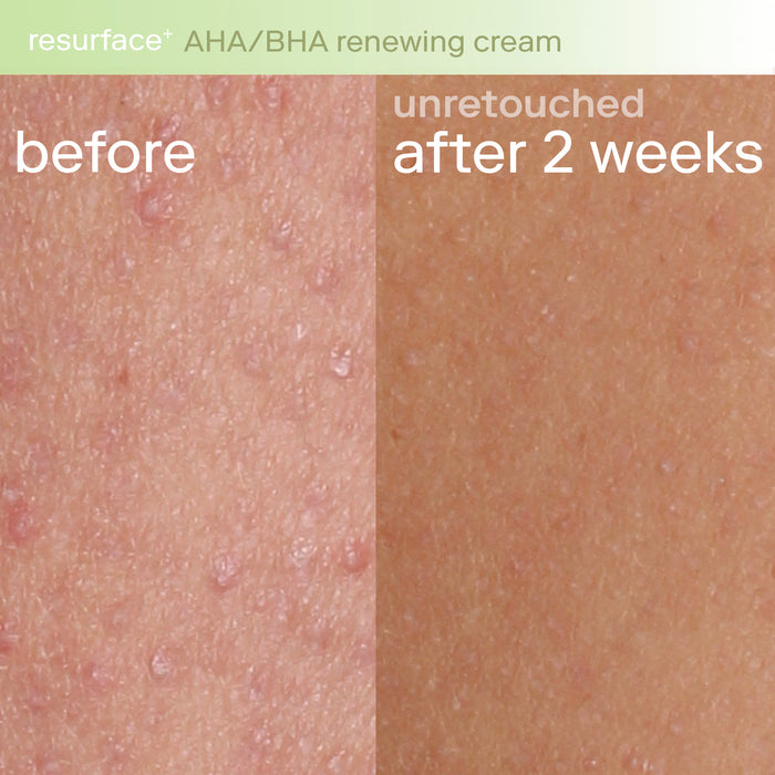 Resurface+ AHA/BHA Renewing Cream Before+After