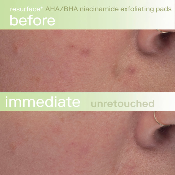 Resurface+ AHA/BHA Niacinamide Exfoliating Pads Before and After Skin