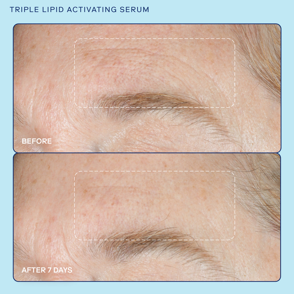 Skinfix Triple Lipid Activating Serum Before and After results showing diminished fine lines