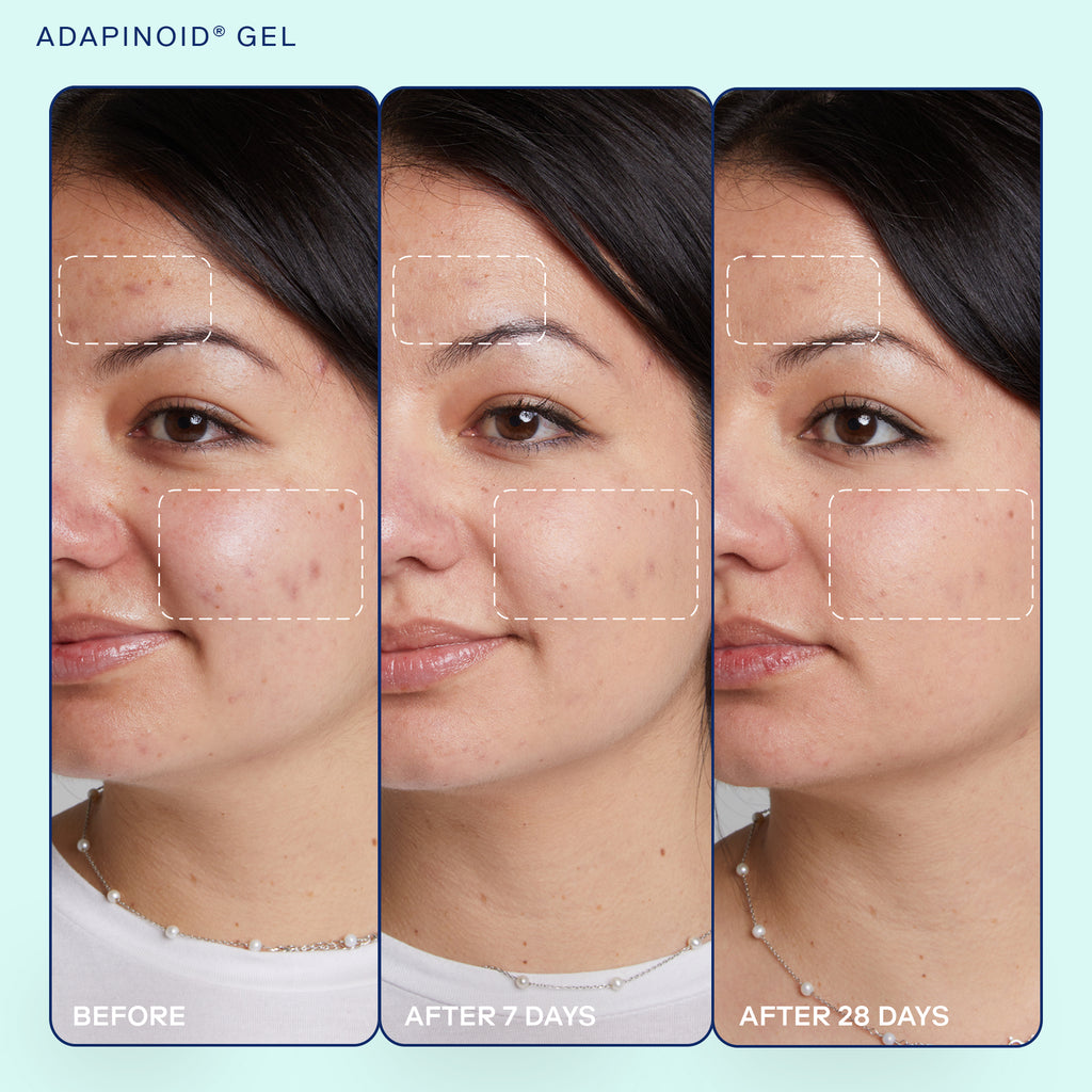 Before and after images showing results after 7 days and after 28 days of using Skinfix Adapinoid Gel.