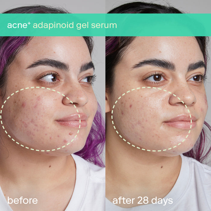 acne+ adapinoid Gel before and after 28 days