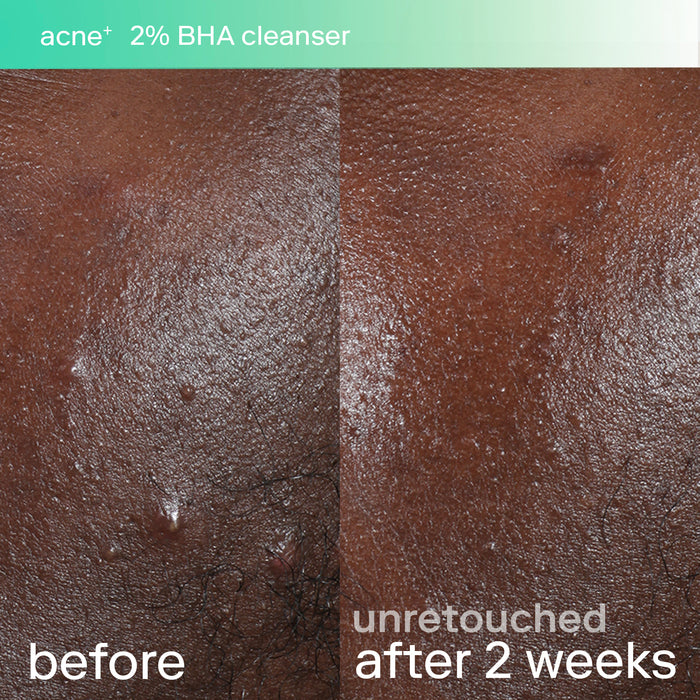 acne+ 2% bha cleanser before and after