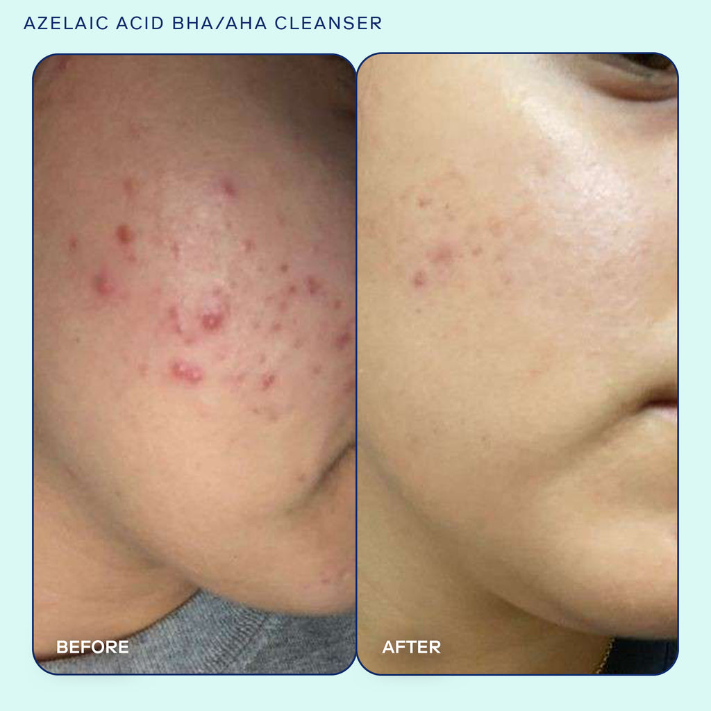 Image showing before and after results after using Skinfix Azelaic Acid BHA/HAHA Cleanser. Skin before showing acne blemishes and after results showing reduction in acne blemishes. 