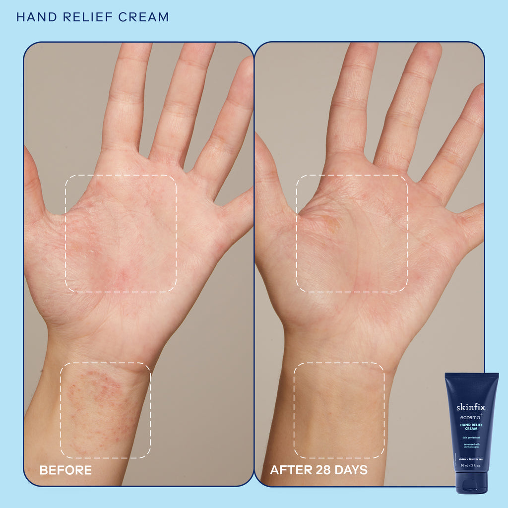 Dr. Lio's Skin Rescue Trio. Before & After image when using Skinfix Hand Relief Cream