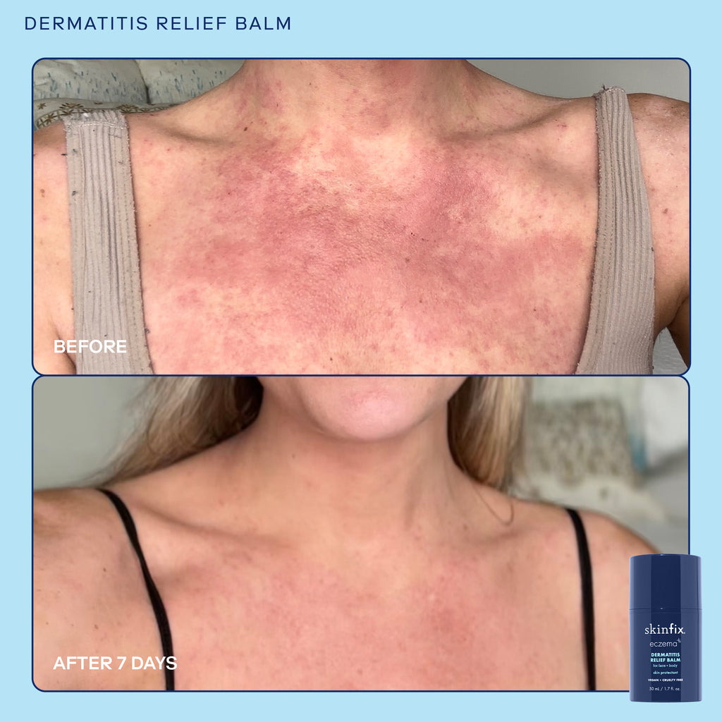 Dr. Lio's Skin Rescue Trio. Before & After image when using Skinfix Dermatitis Relief Balm