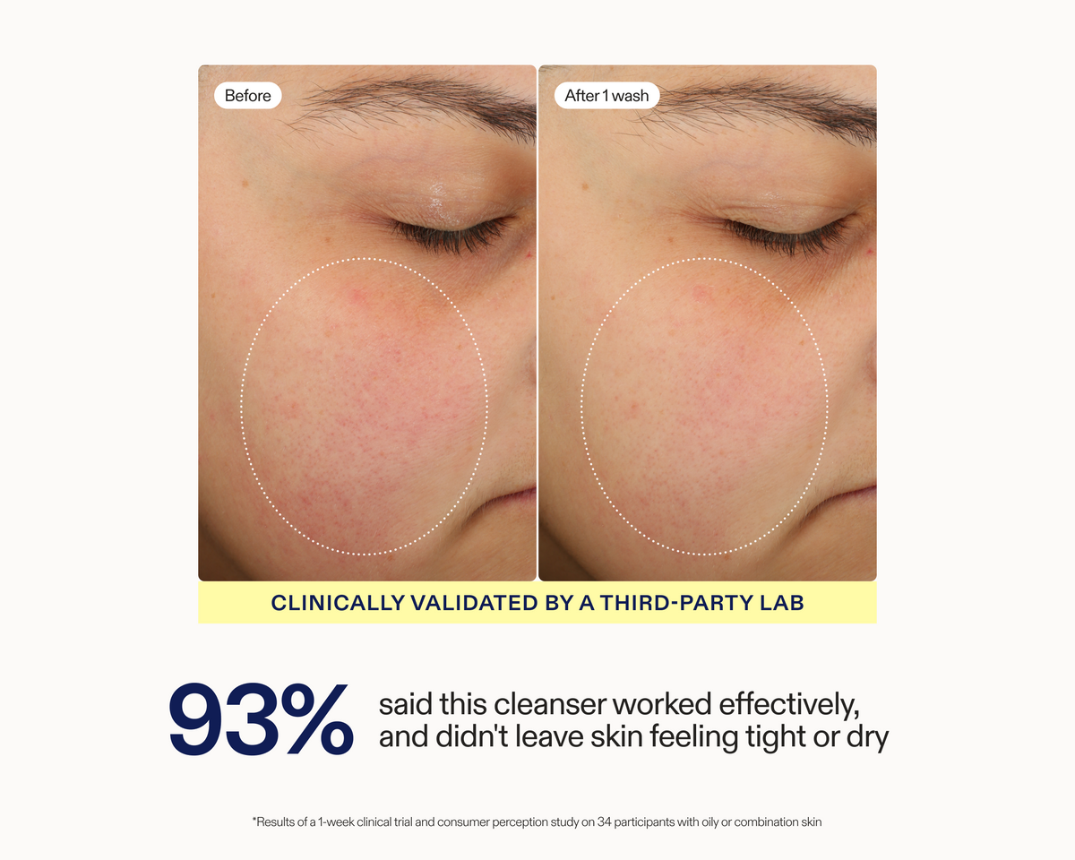 Before and after comparison of facial skin clarity on a person's cheek, with text stating 'Clinically validated by a third-party lab' and '93% said this cleanser worked effectively, and didn't leave skin feeling tight or dry'.