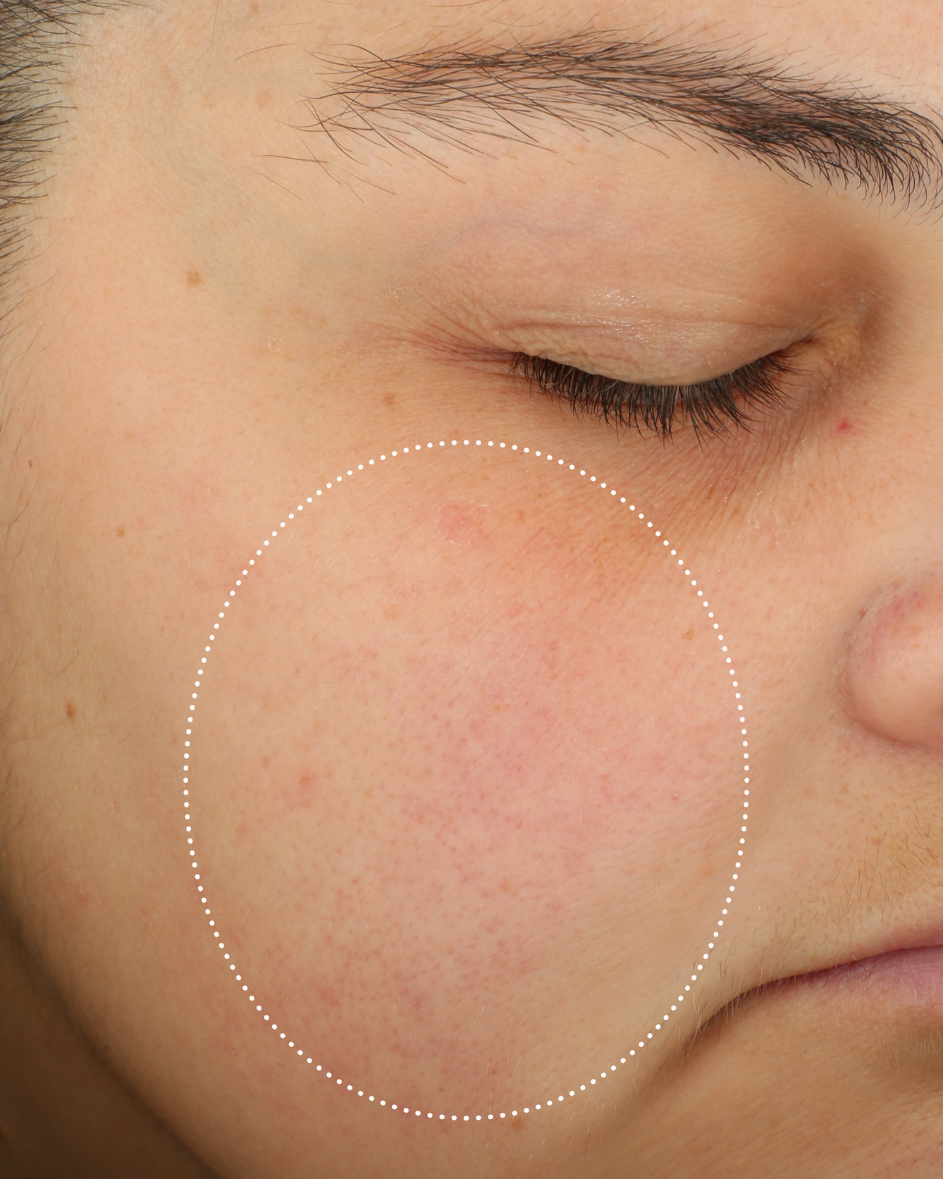 Close-up of the same person’s cheek after cleansing, highlighted by a dotted circle.
