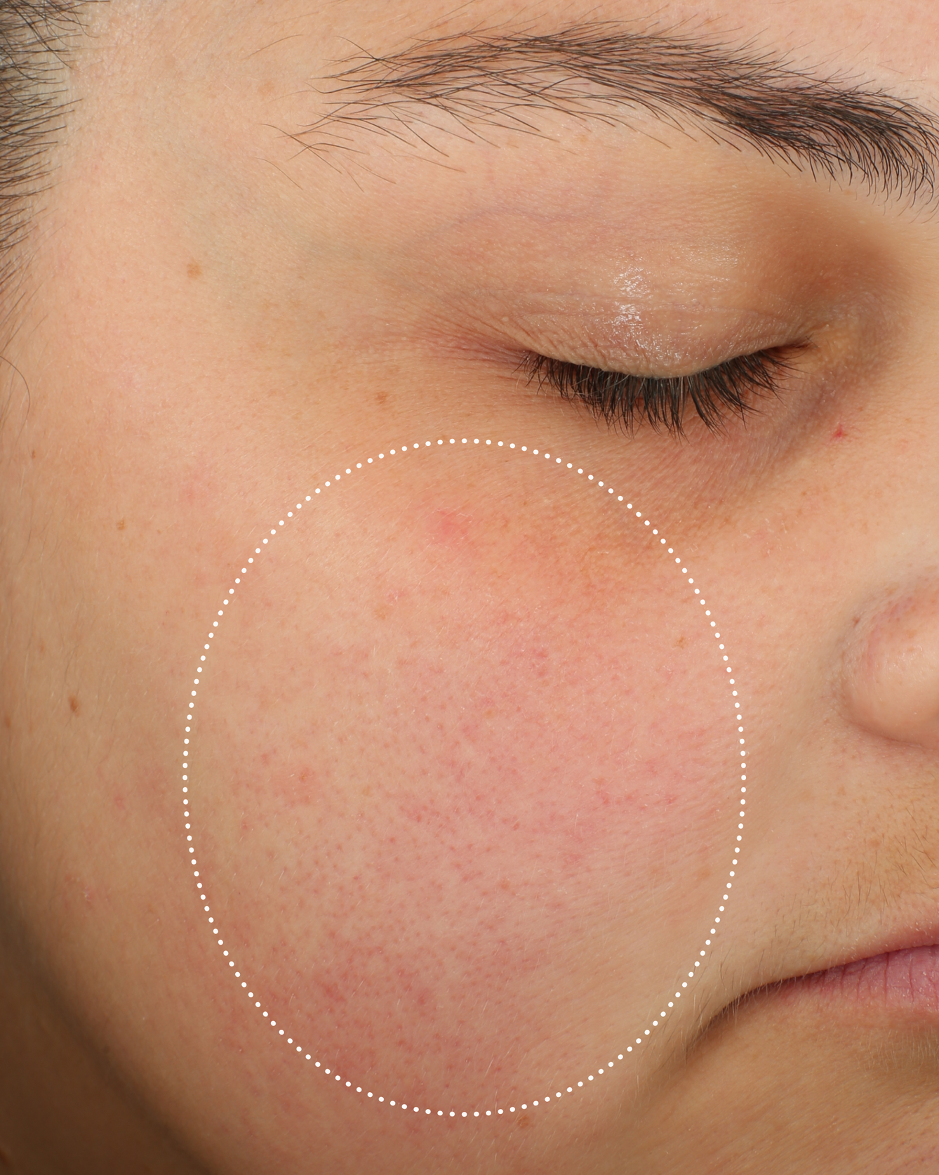 Close-up of a person’s cheek with visible redness before cleansing, highlighted by a dotted circle.