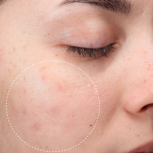 Close-up of same cheek with reduced redness and blemishes circled, after using Hypochlorous Daily Mist.
