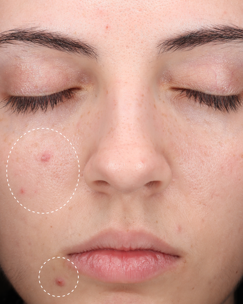 Close-up of cheek and lip area with blemishes circled, before using Hypochlorous Daily Mist.