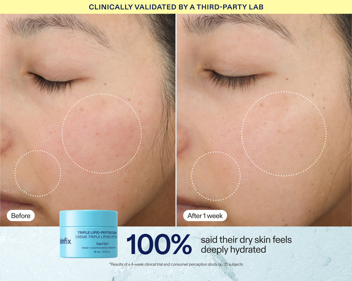 Before-and-after skin comparison showing a person's cheek with acne and redness on the left, and clearer, more hydrated skin on the right. A light blue jar of Triple Lip Treatment Deep Hydration Serum is shown at the bottom with text stating 'Clinically validated by a third-party lab' and '100% said their dry skin feels deeply hydrated'.