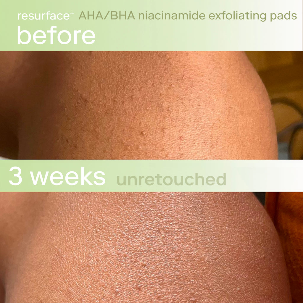 Resurface+ AHA/BHA Niacinamide Exfoliating Pads before and After Body