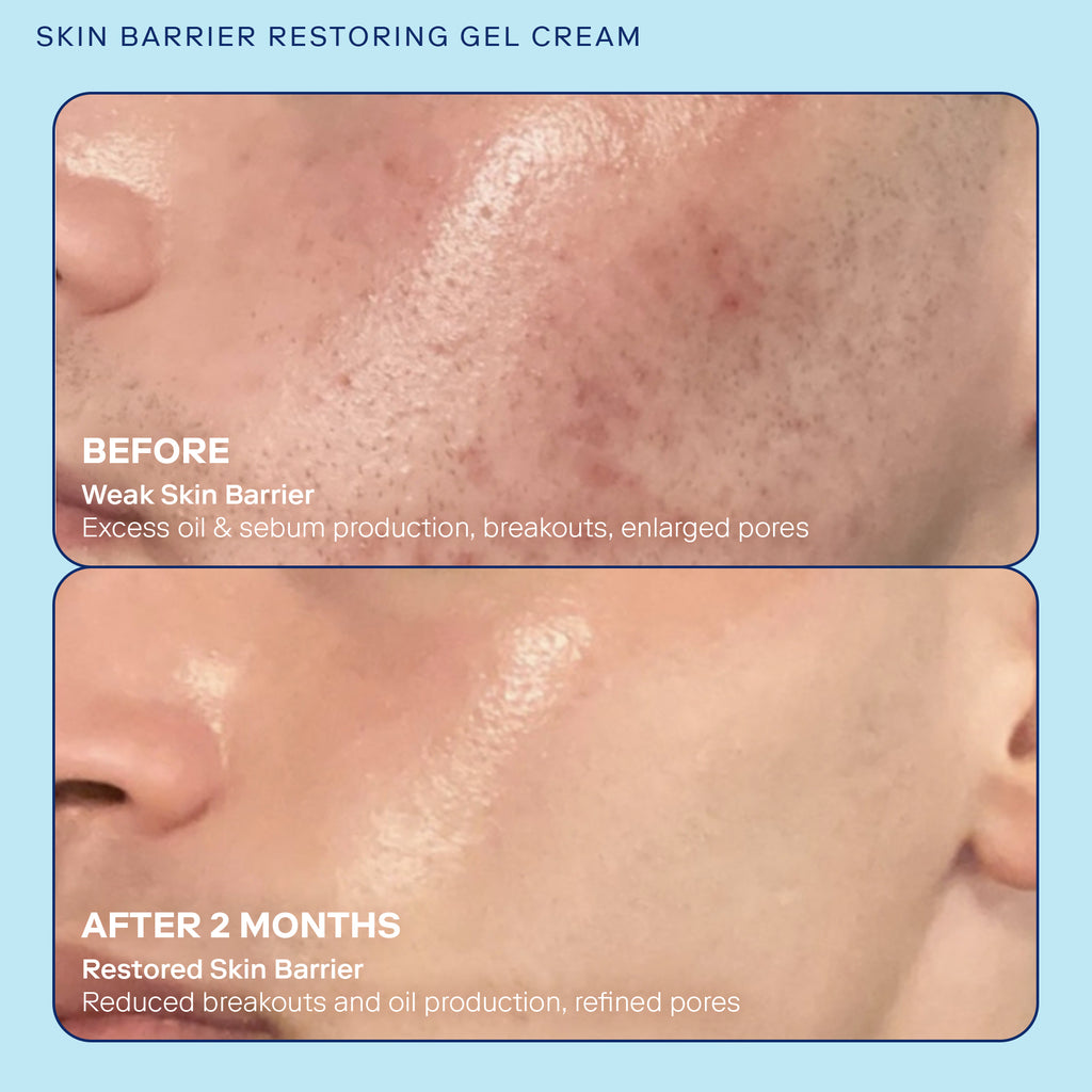 Skinfix Skin Barrier Restoring Gel Cream before and after image