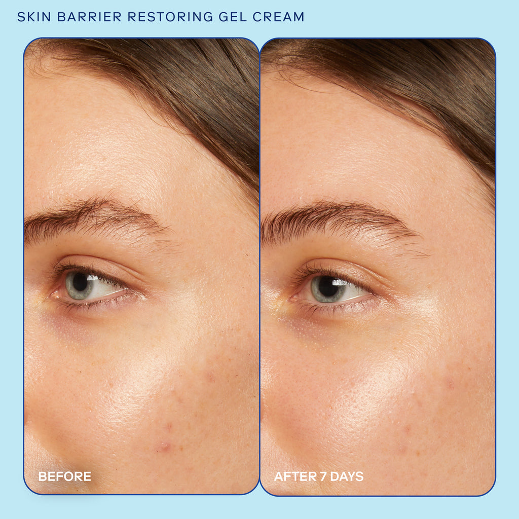 Skinfix Skin Barrier Restoring Gel Cream before and after image