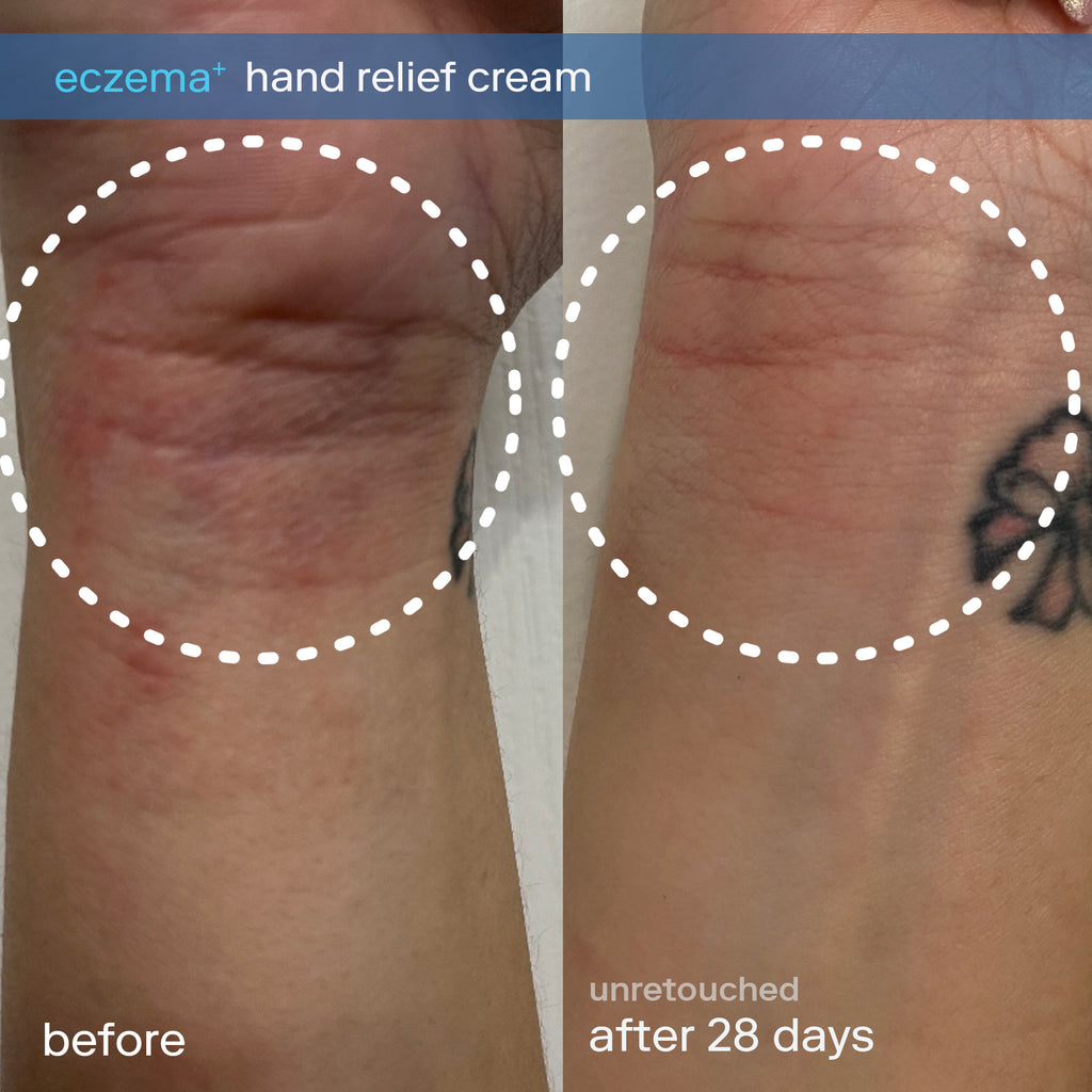 Image of before and after results showing difference in eczema flare-up on wrist after using Skinfix Hand Relief Cream