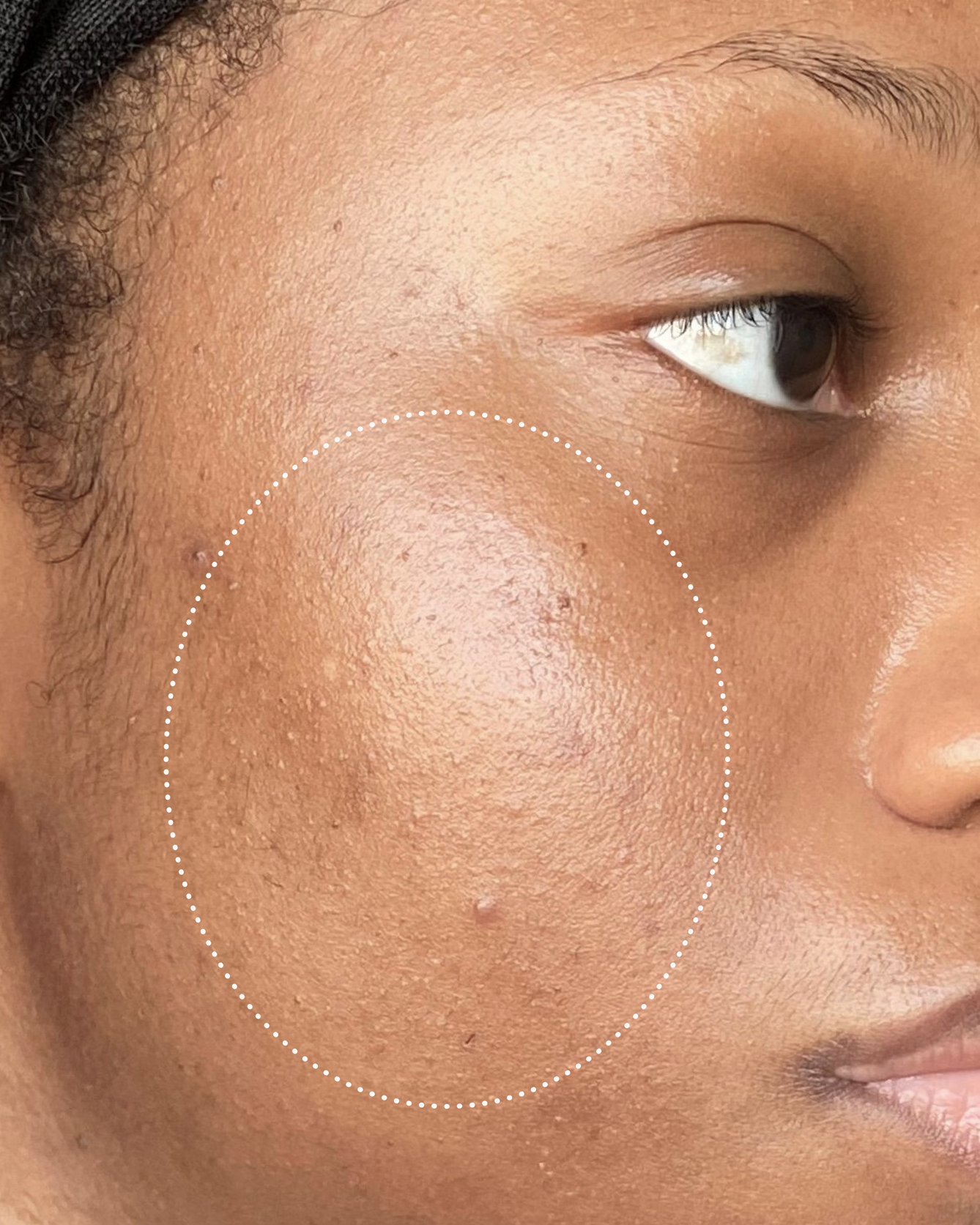 Close-up of a person's eye and forehead with visibly improved skin texture.