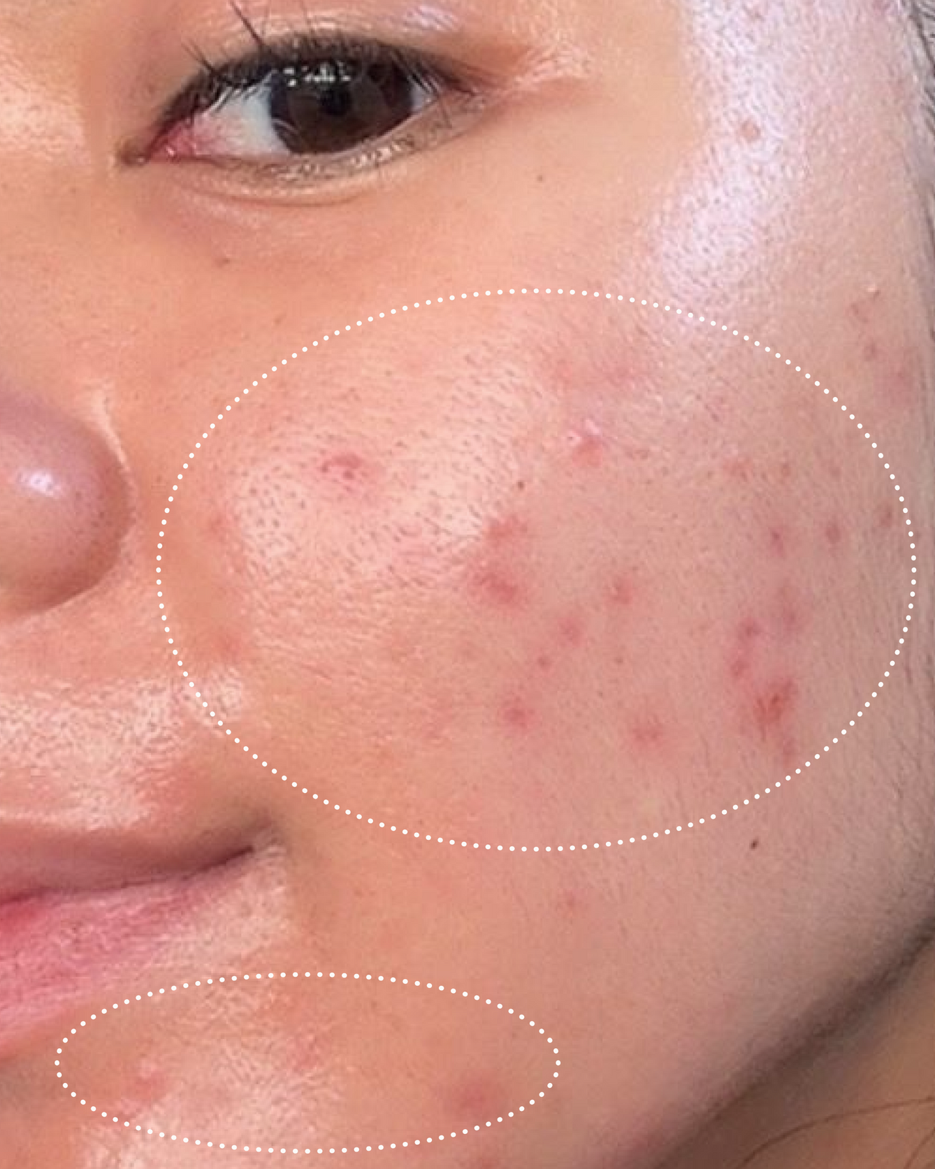 Close-up of a person's face with visible blemishes on the skin.