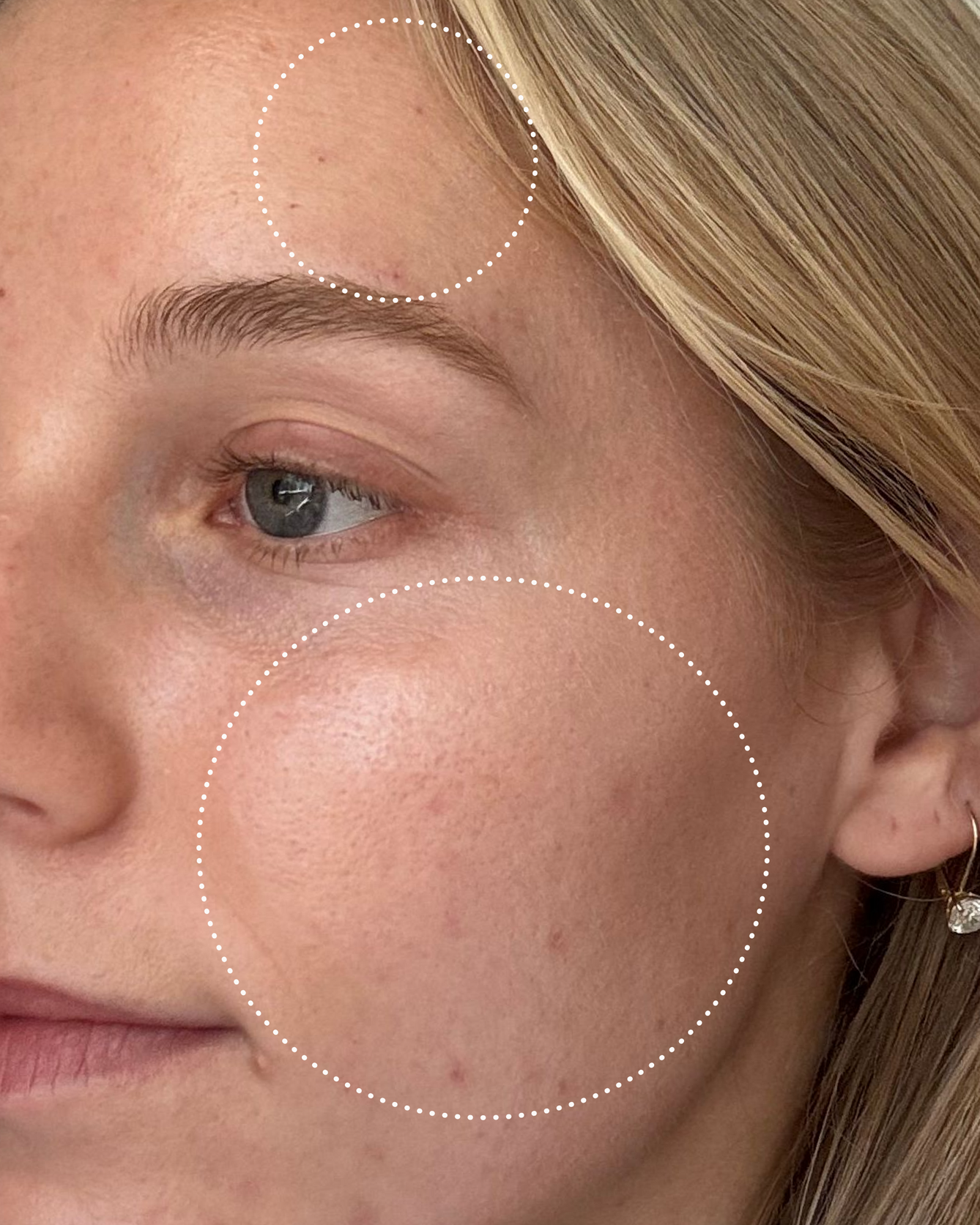 Close-up of a person's face with circles highlighting skin texture and dark spots.