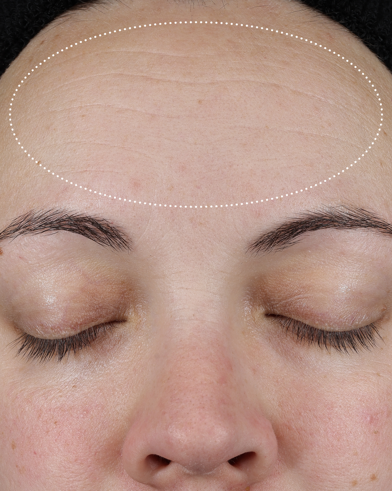 Clinical before photo showing forehead skin with visible fine lines and uneven texture, with a dotted oval highlighting the treatment area.