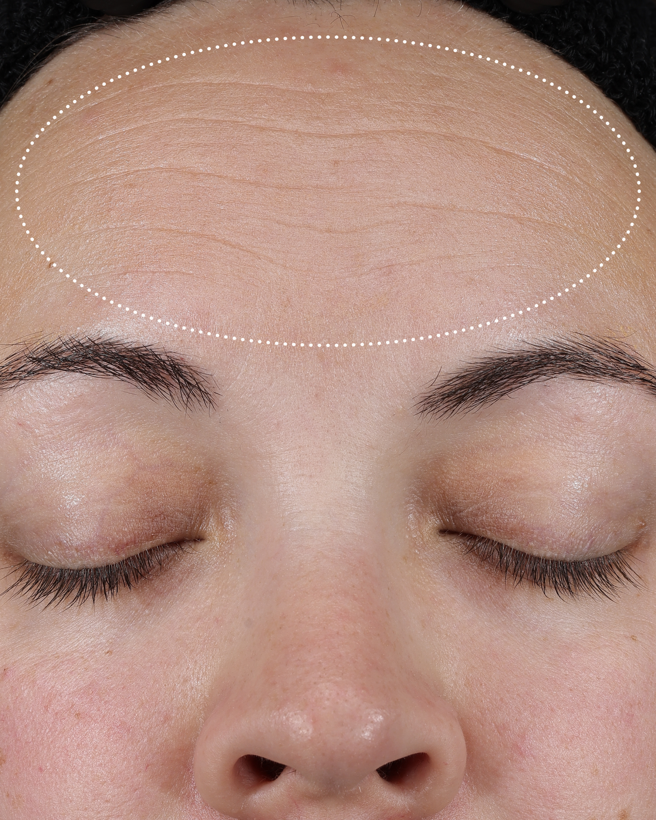 Clinical before photo showing forehead skin with visible fine lines and uneven texture, with a dotted oval highlighting the treatment area.