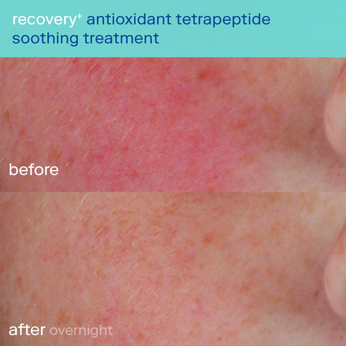 Antioxidant Tetrapeptide Soothing Treatment before & after