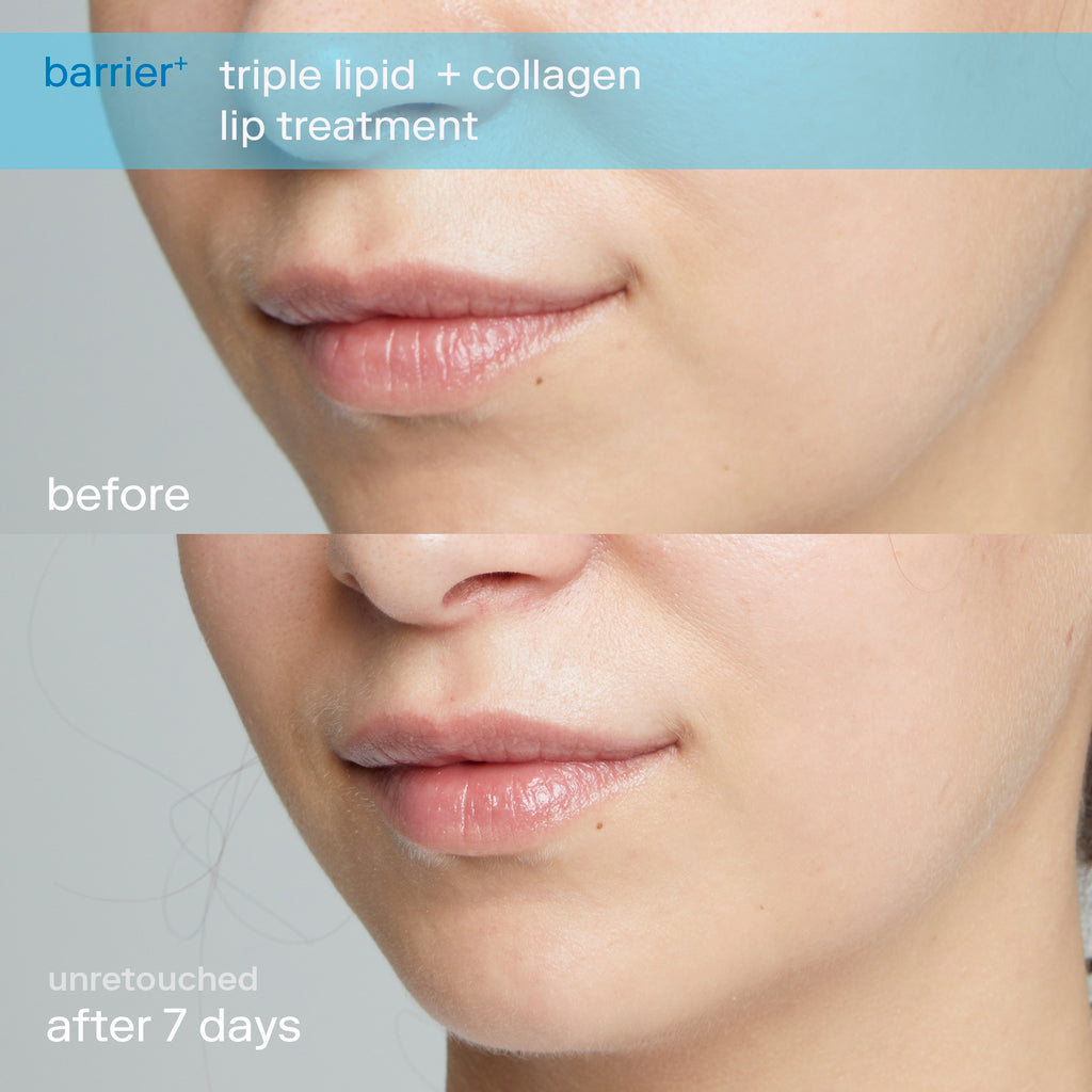 triple lipid + collagen lip treatment before and after 2