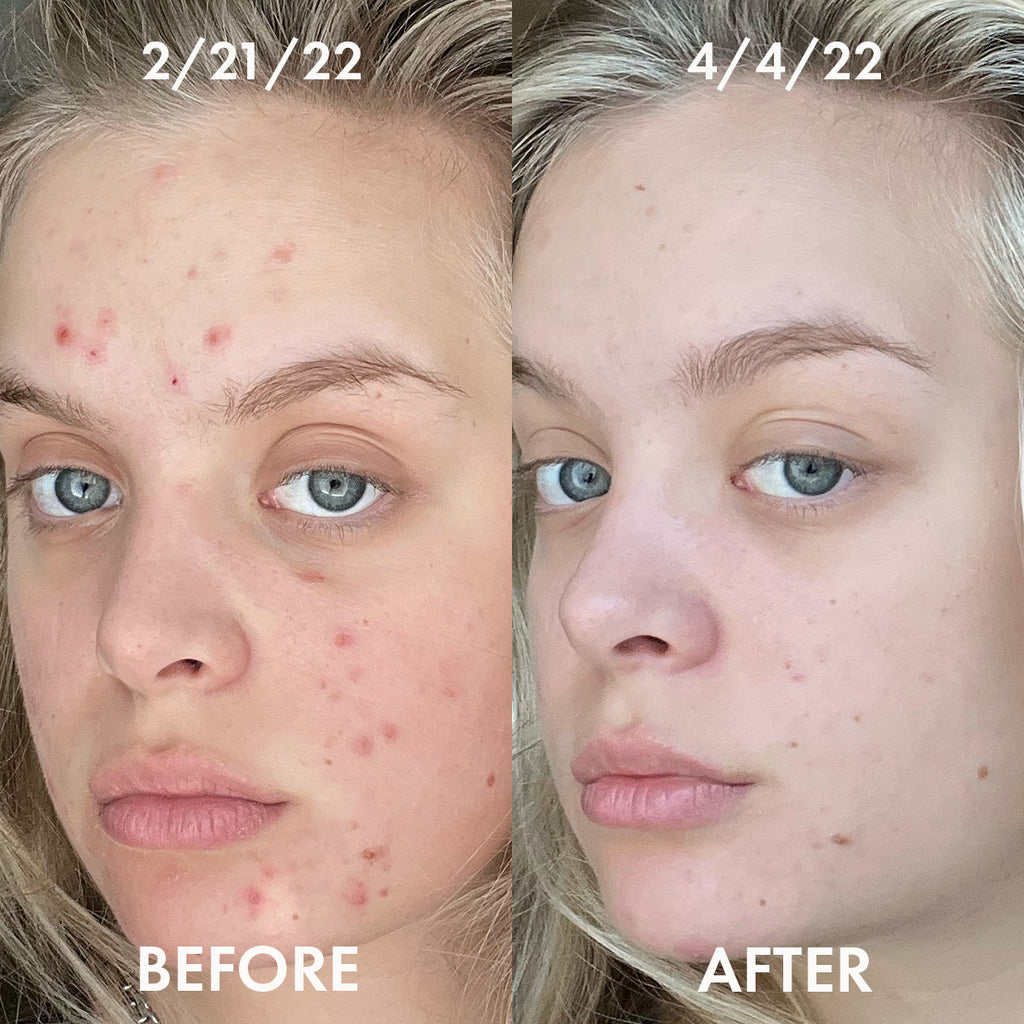 acne+ regimen before + after