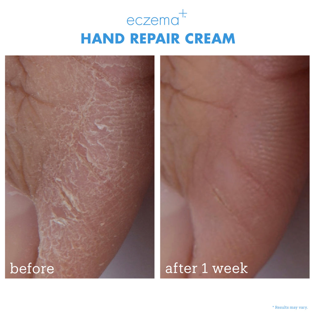eczema+ hand repair cream before + after 1 week