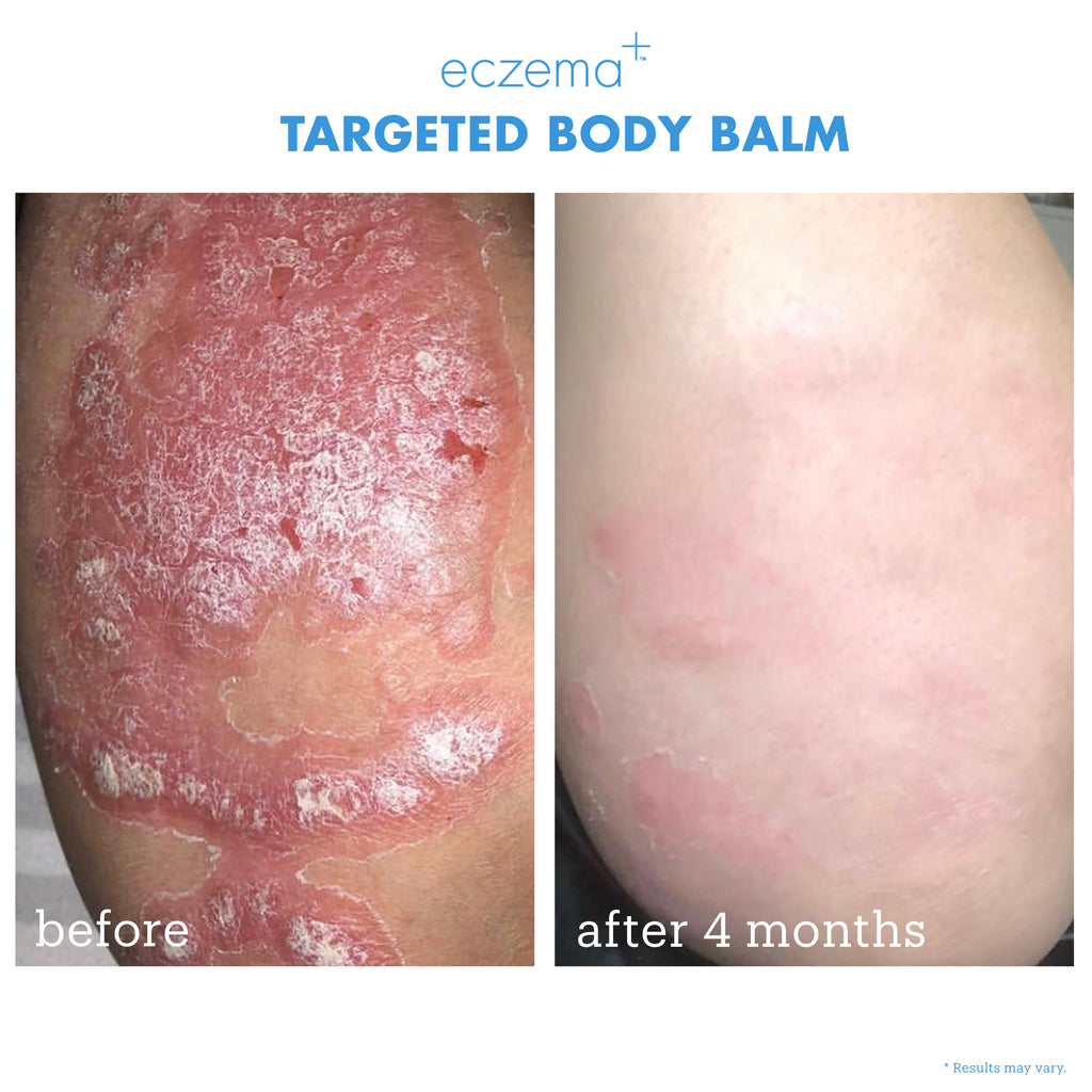 eczema+ targeted body balm before + after 4 months